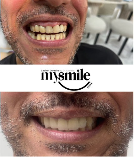 un patient qui montre la difference de ses dents avant et après les soins dentaires.